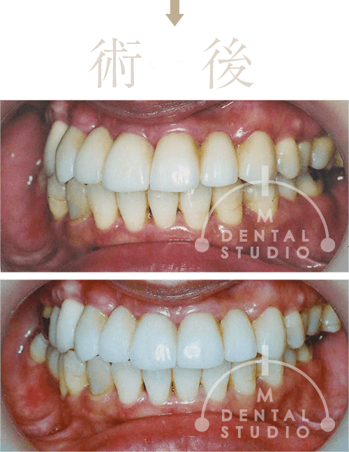 重度 インプラント10本以上必要と診断されたのですが 治療実績集 歯周病治療 大阪の歯科クリニック Mdental Studio